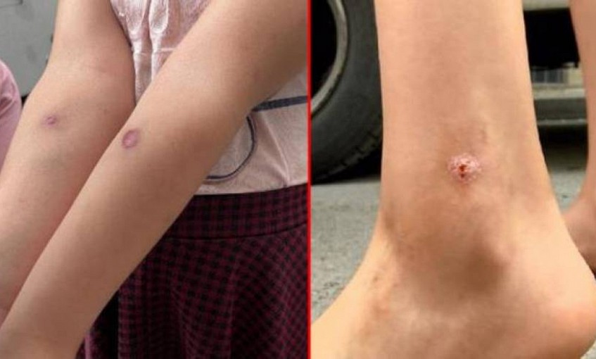 Korona bitmeden yeni kabus başladı! İstanbul'da sivrisinek sokan çocuklarda yaralar oluştu